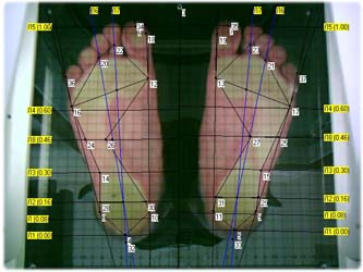Подбор ортопедических изделий с помощью плантоскопа